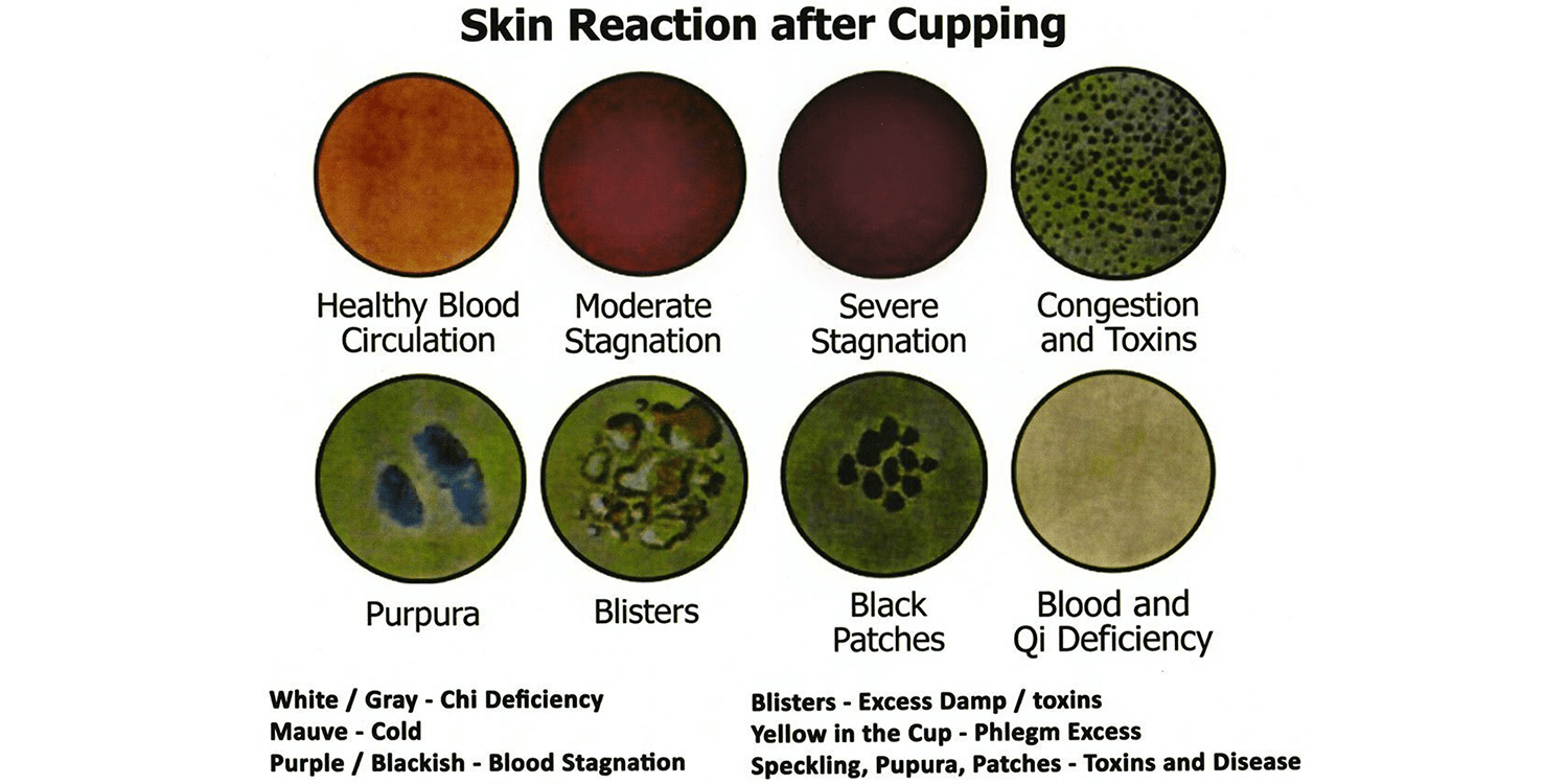 Skin Reaction After Cupping – Al Ghufran Hijamah